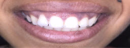 Gummy Smile correction with Laser Gum Lift - Before