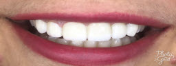 Smile makeover with porcelain veneers - After