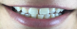 Smile makeover with porcelain veneers - Before