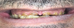 rehabilitation with metal free crowns bridge - Before