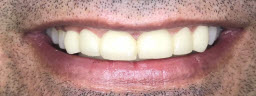 rehabilitation with metal free crowns bridge - After