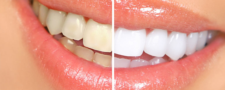 Tooth Whitening