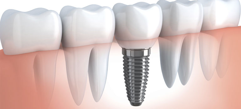 Implant Dentistry