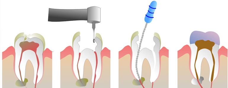 Root Canal