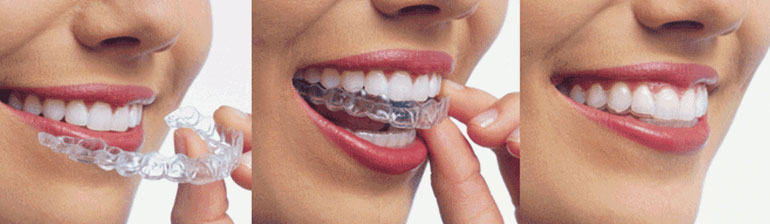 Clear Aligners